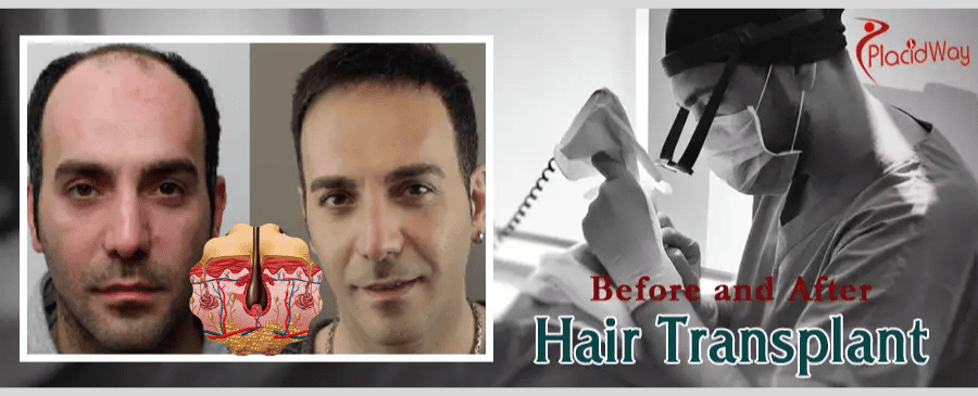 Turkish hair transplant results