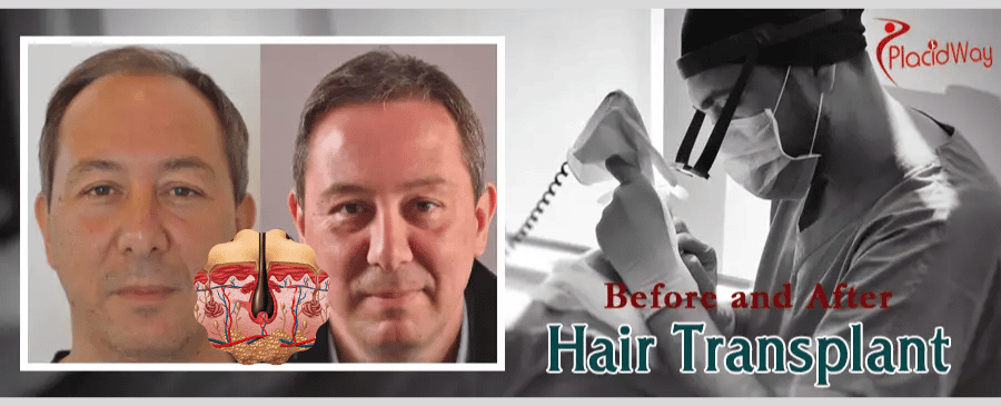 hair transplant results