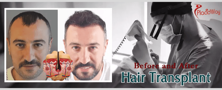 best hair transplant results