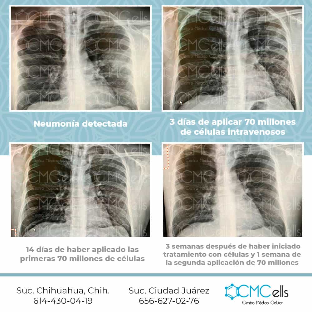 Testimonio Celulas En Neumonia