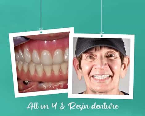 Dental Implant in Los Algodones Mexico by Navarro