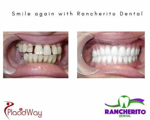 Before and After Dental Treatment in Los Algodones Mexico by Rancherito Dental