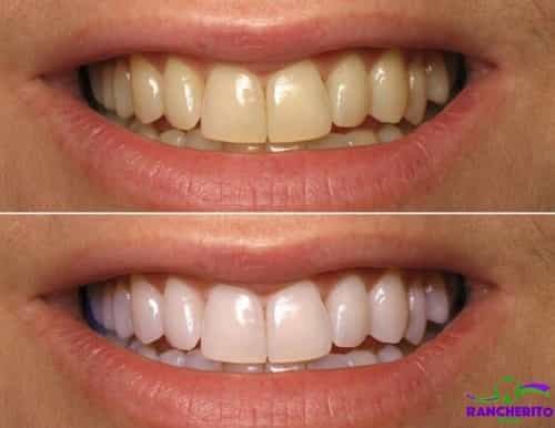 Before and After Dental Treatment in Los Algodones Mexico by Rancherito Dental