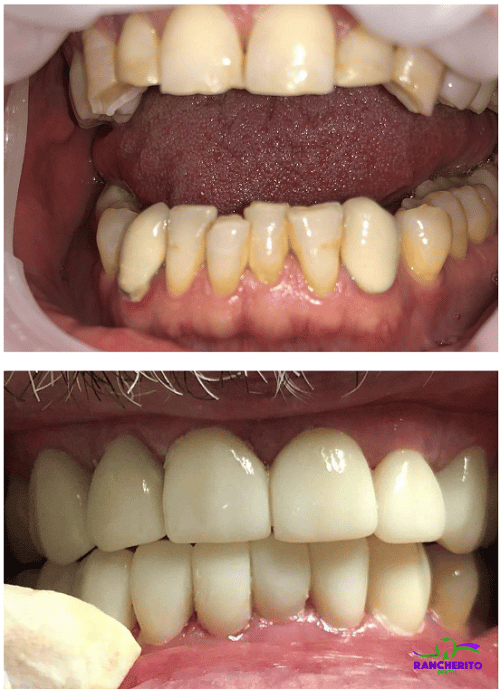 Complete Oral Rehab | Rancherito Dental