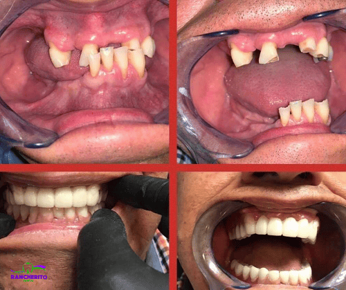 Complete Oral Rehabilitation | Rancherito Dental
