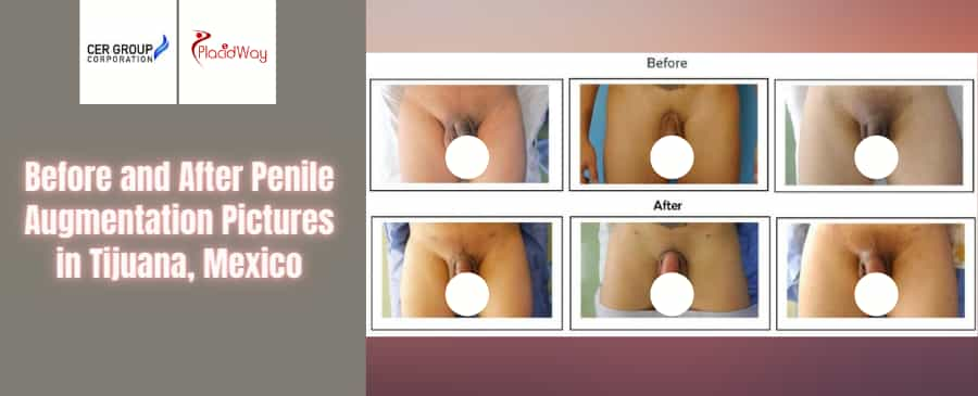 Before and After Penile Augmentation Surgery in Tijuana at CER Group