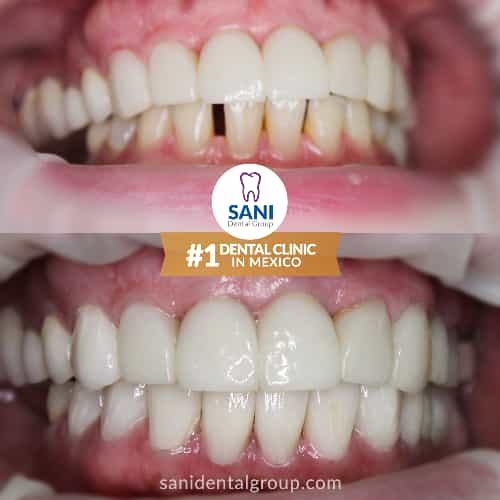 Sani Dental Group - Before and After dental implant in Los Algodones