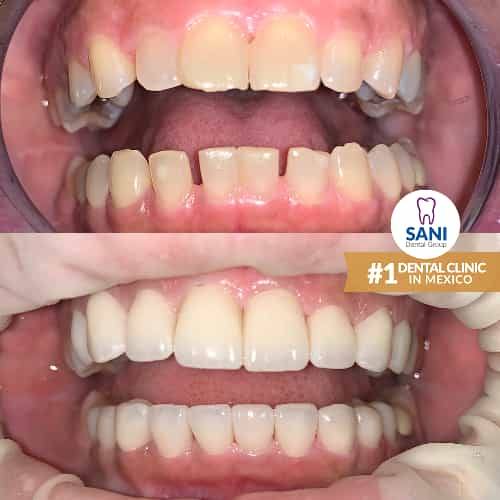 Sani Dental Group - Before and After veneers in Los Algodones