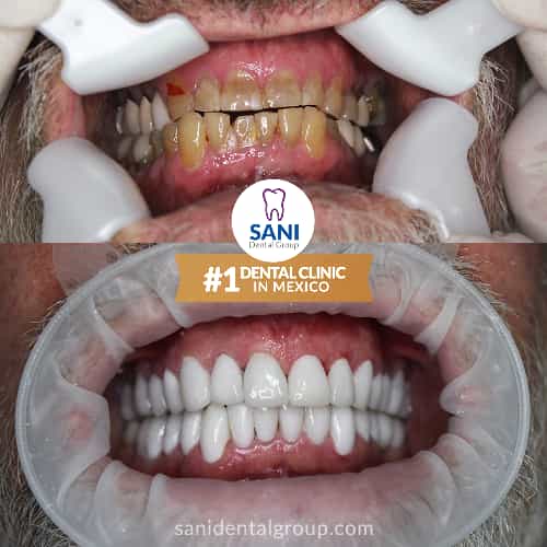 Sani Dental Group - Before and After dental veneers in Los Algodones