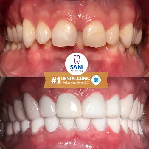 Sani Dental Group - Before and After dental crowns in Los Algodones