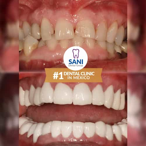 Sani Dental Group - Before and After dental veneers in Los Algodones