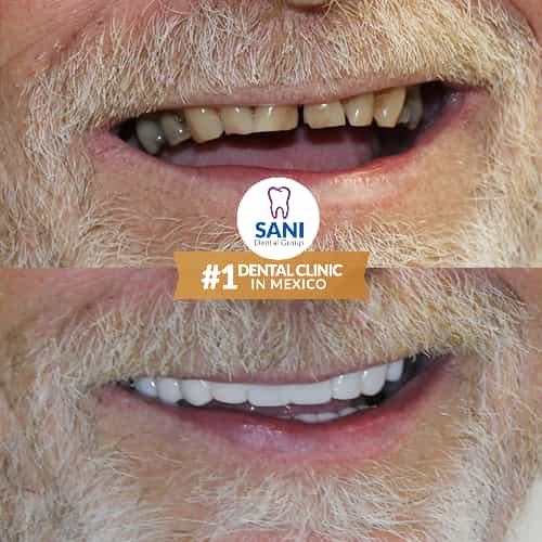 Sani Dental Group - Before and After veneers in Los Algodones