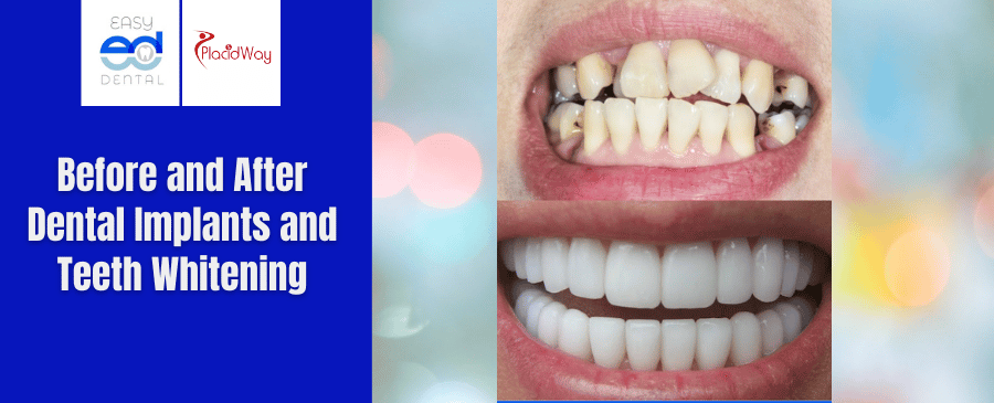 Before and After Dental Implants and Teeth Whitening