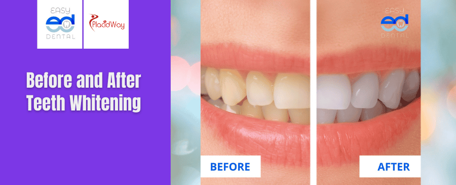 Before and After Teeth Whitening