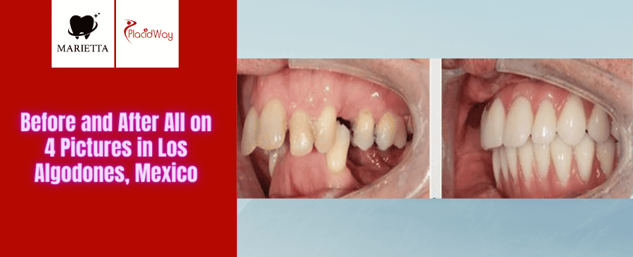 Before and After All on 4 Dental Implants in Los Algodones