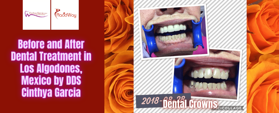 Before and After Dental Treatment Pictures in Los Algodones, Mexico by DDS Cinthya Garcia