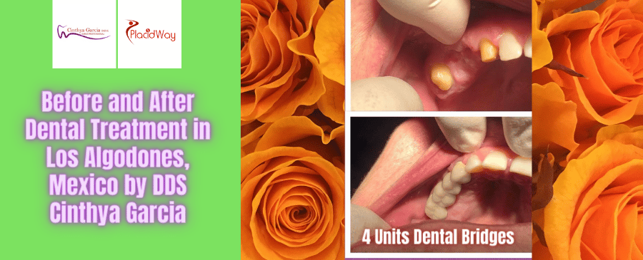 Before and After Dental Treatment Pictures in Los Algodones, Mexico by DDS Cinthya Garcia