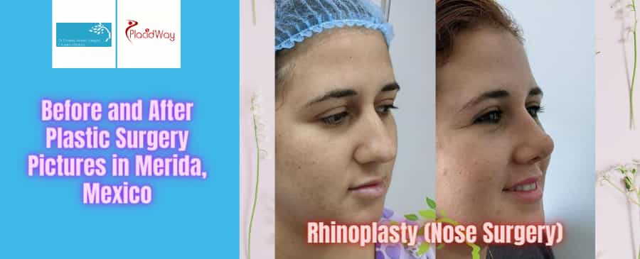 Before and After Plastic Surgery Pictures in Merida, Mexico