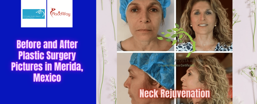 Before and After Plastic Surgery Pictures in Merida, Mexico