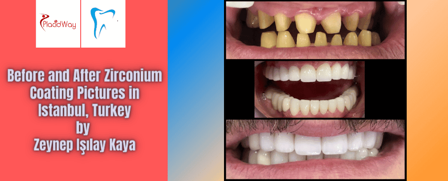 Before and After Zirconium Coating