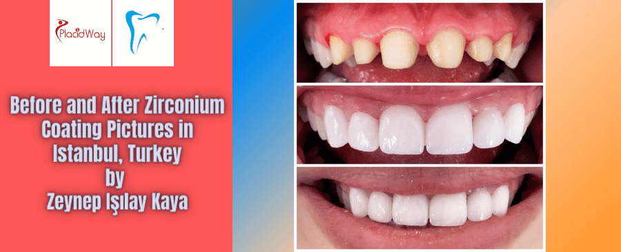 Before and After Zirconium Coating