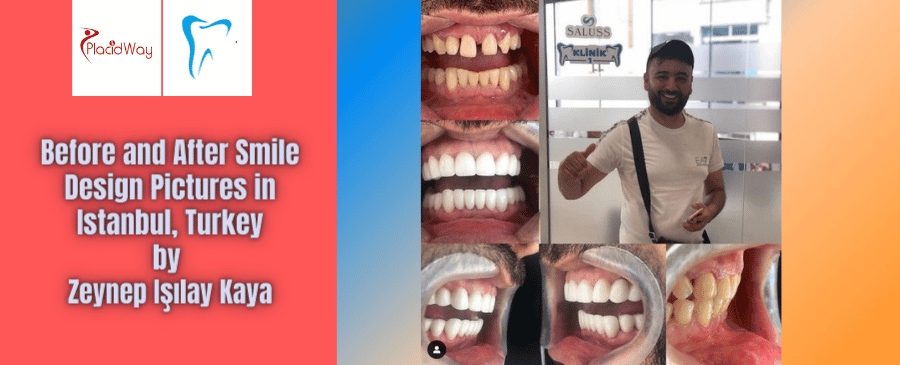 Before and After Smile Design