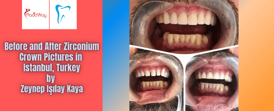 Before and After Zirconium Crown