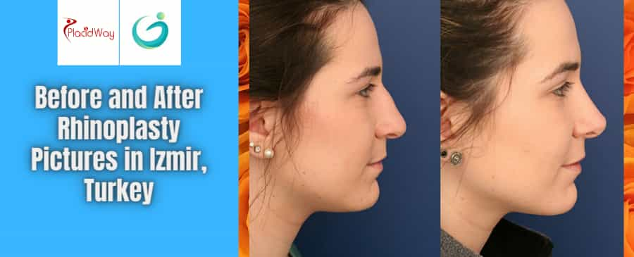 Before and After Rhinoplasty in Izmir, Turkey at Hermes Clinic