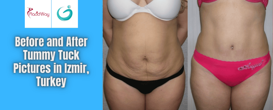 tummy tuck before and after