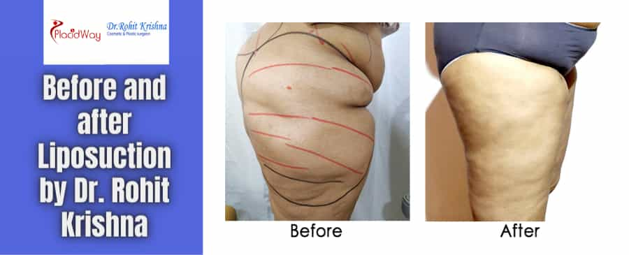 Liposuction Before and After