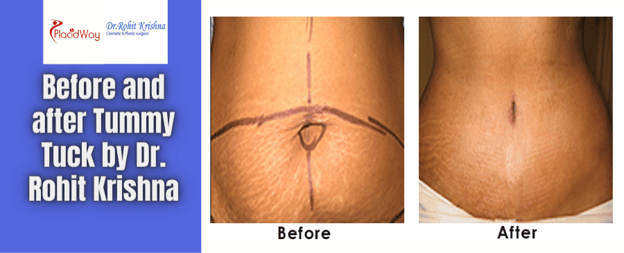 Tummy Tuck Before and After