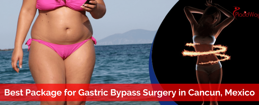 Gastric Bypass Surgery in Cancun, Mexico