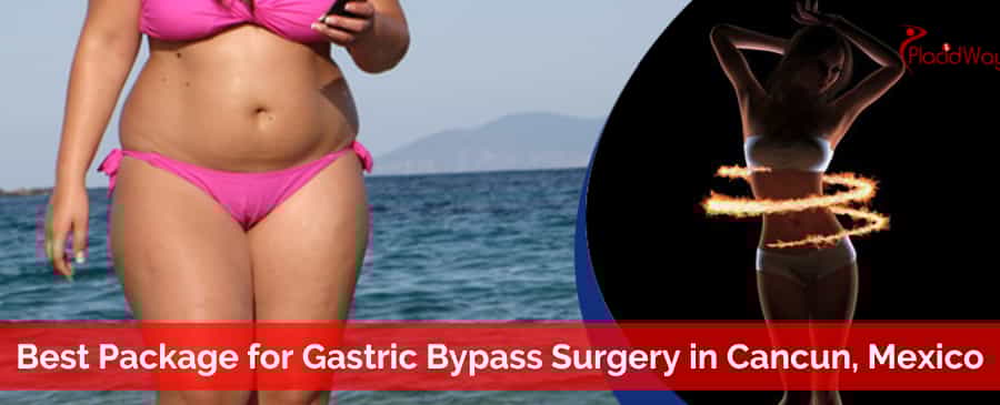 Gastric Bypass Surgery in Cancun, Mexico