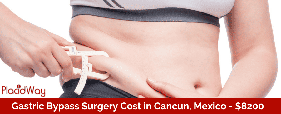 Gastric Bypass Cost in Cancun, Mexico