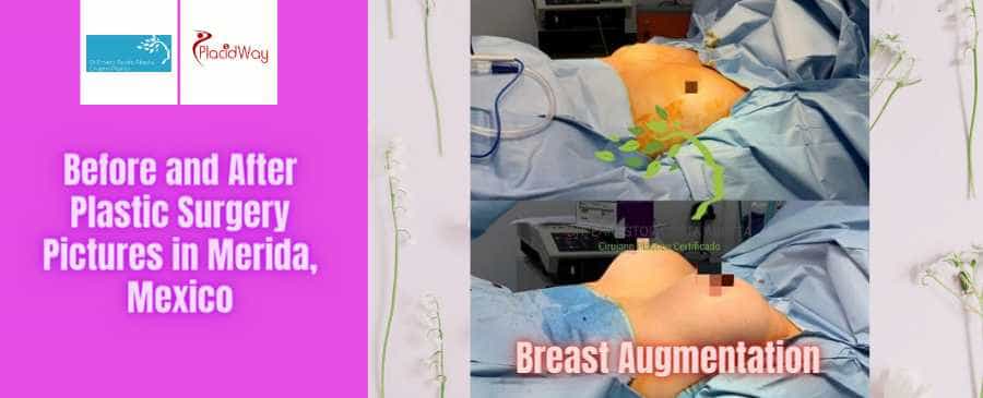 Before and After Breast Lift in Merida Mexico