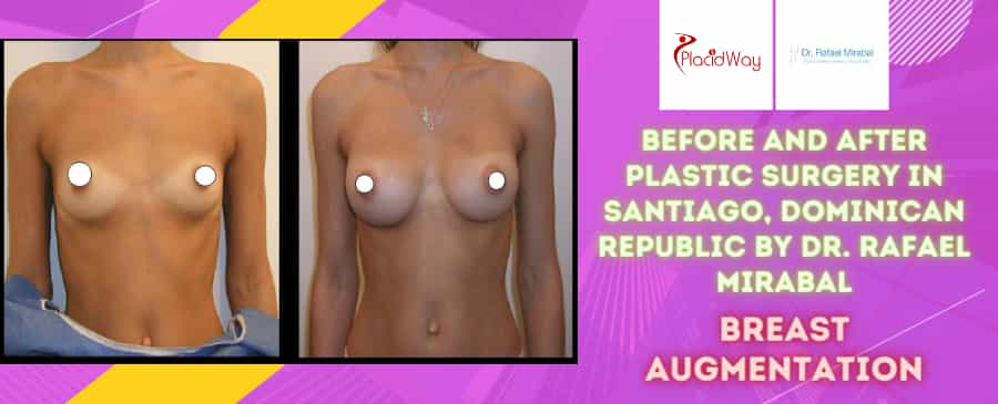 Before and After Breast Augmentation Surgery in Dominican Republic