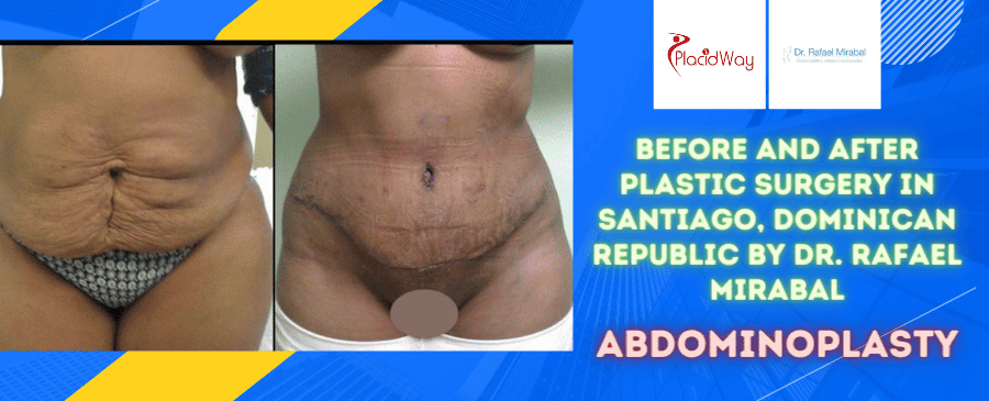 Before and After Abdominoplasty Surgery in Santiago, Dominican Republic