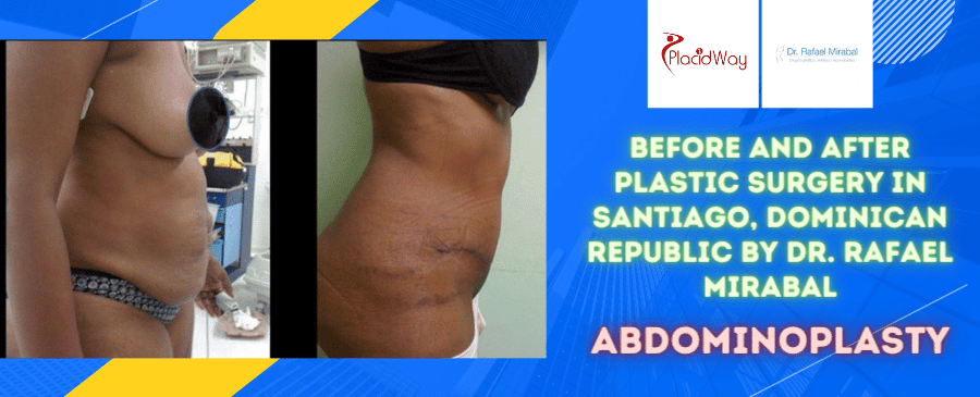 Before and After Abdominoplasty Surgery in Santiago, Dominican Republic