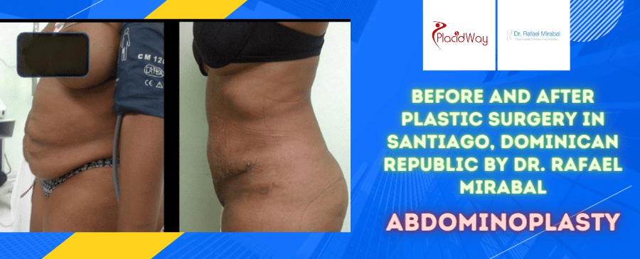 Before and After Abdominoplasty Surgery in Santiago, Dominican Republic