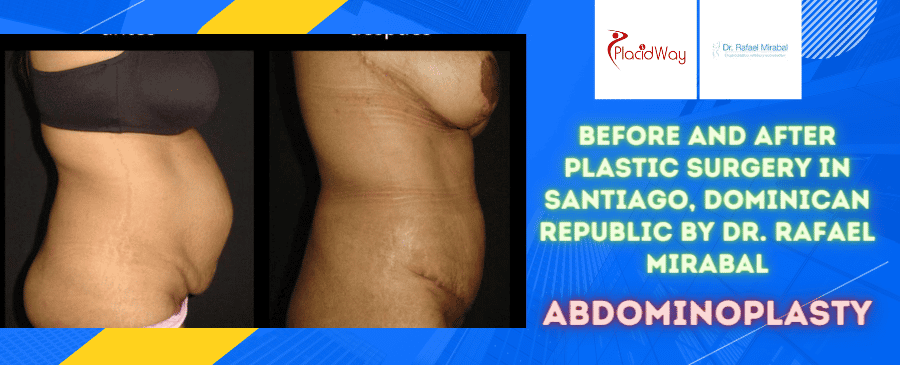 Before and After Abdominoplasty Surgery in Santiago, Dominican Republic