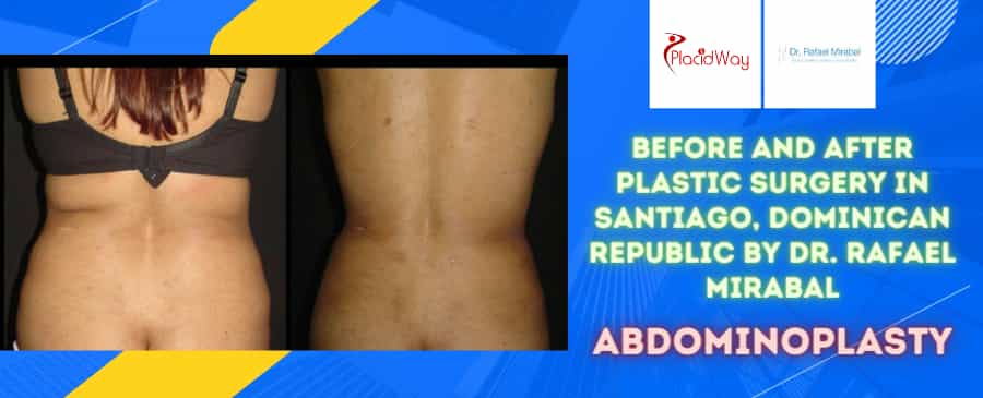 Before and After Abdominoplasty Surgery in Santiago, Dominican Republic