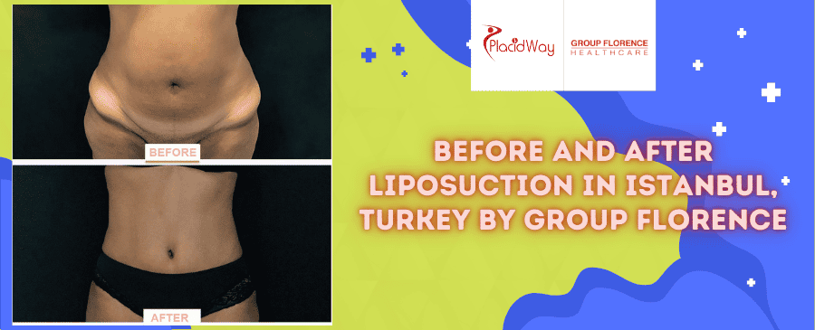 Before and After Liposuction in Istanbul, Turkey by Group Florence