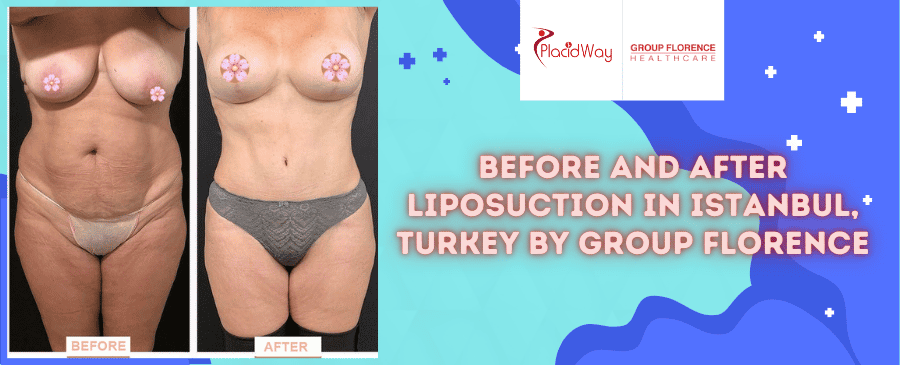 Before and After Liposuction in Istanbul, Turkey by Group Florence