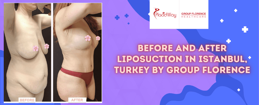 Before and After Liposuction in Istanbul, Turkey by Group Florence