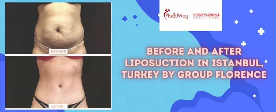 Before and After Liposuction in Istanbul, Turkey by Group Florence