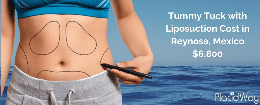 Tummy Tuck in Mexico Cost with Liposuction