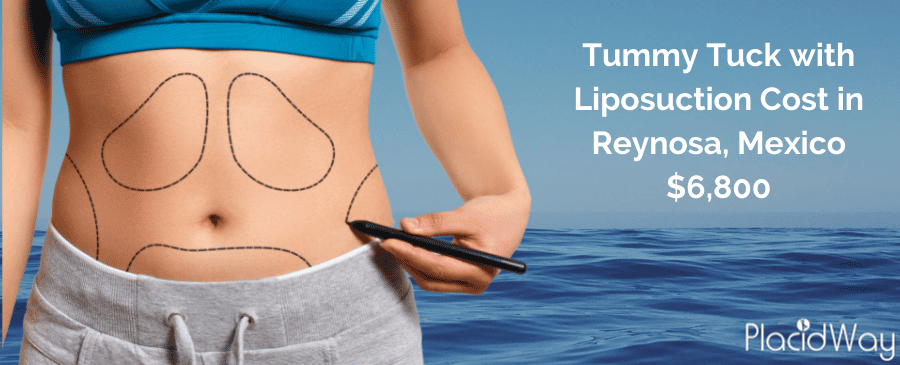 Tummy Tuck in Mexico Cost with Liposuction