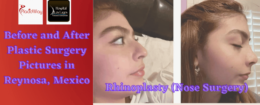 Rhinoplasty Nose Surgery