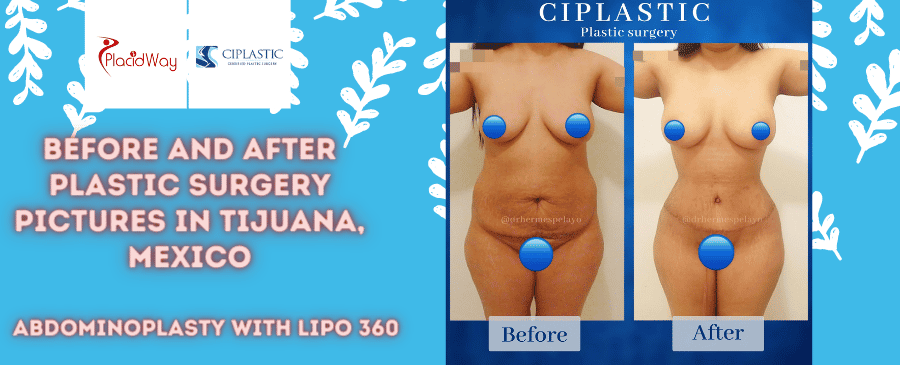 Before and After Abdominoplasty with Lipo 360 in Tijuana, Mexico