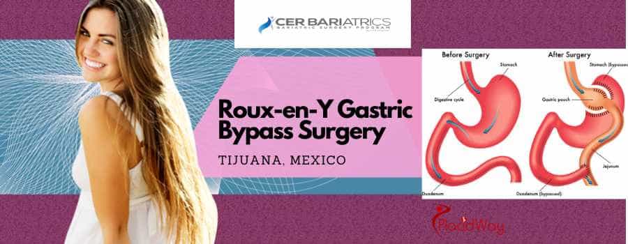 Gastric Bypass Package in Tijuana, Mexico by CER